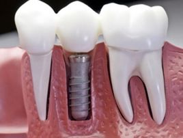 单颗牙缺失种植牙修复案例