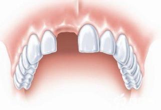 什么原因会造成缺牙？缺牙对生活会产生什么样的影响？