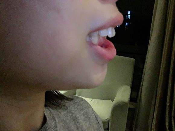 矫正龅牙费用一般需要多少?